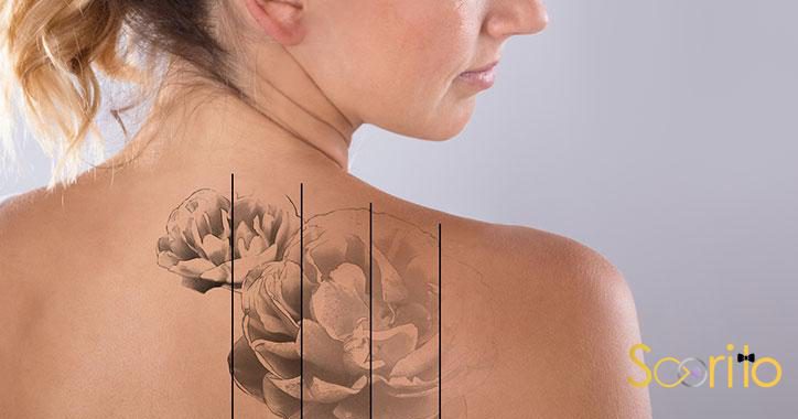 پاک کردن تاتو