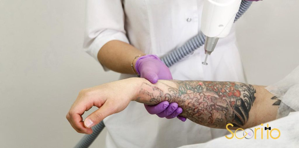 پاک کردن تاتو